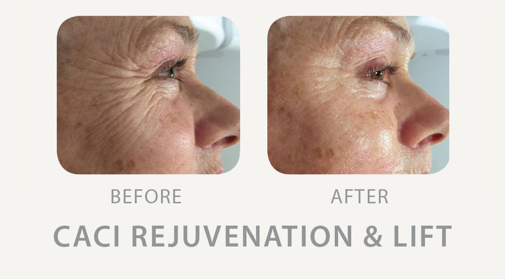 CACI facials Wimbledon Clinic Aesthetics Amazing CACI treatment results