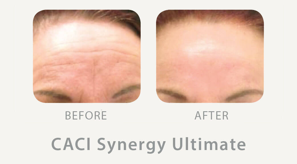 CACI facials Wimbledon Clinic Aesthetics Amazing CACI treatment results