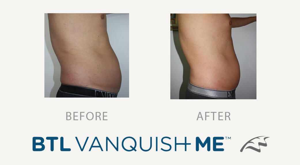 Vanquish male abdominal tummy fat before and afters