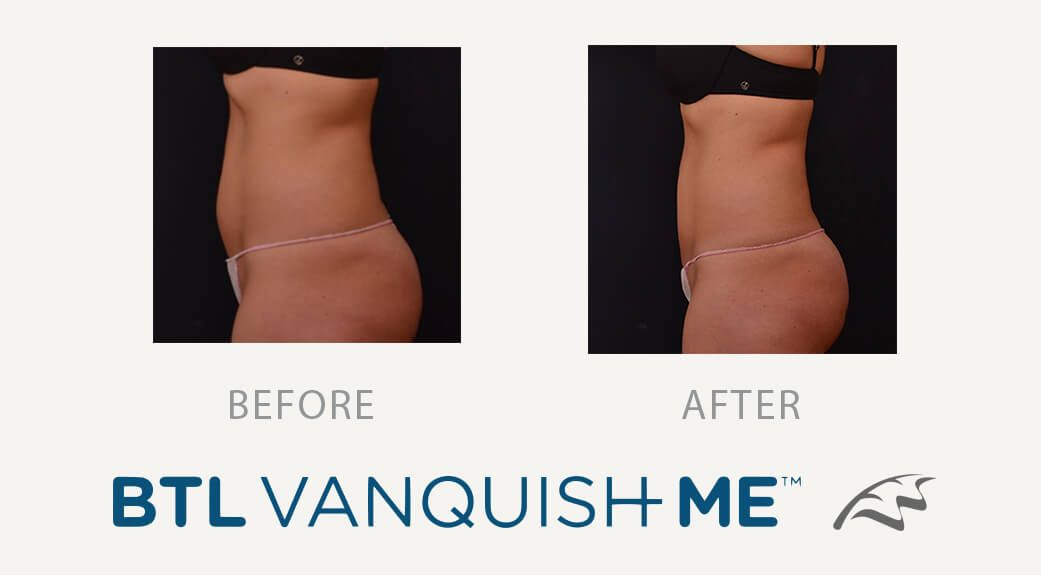 Vanquish abdominal tummy fat before and afters wimbledon treatment