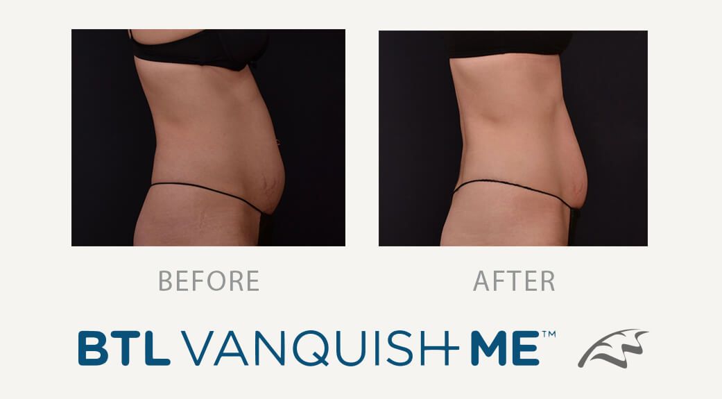 Vanquish abdominal tummy fat before and afters wimbledon belly fat removal