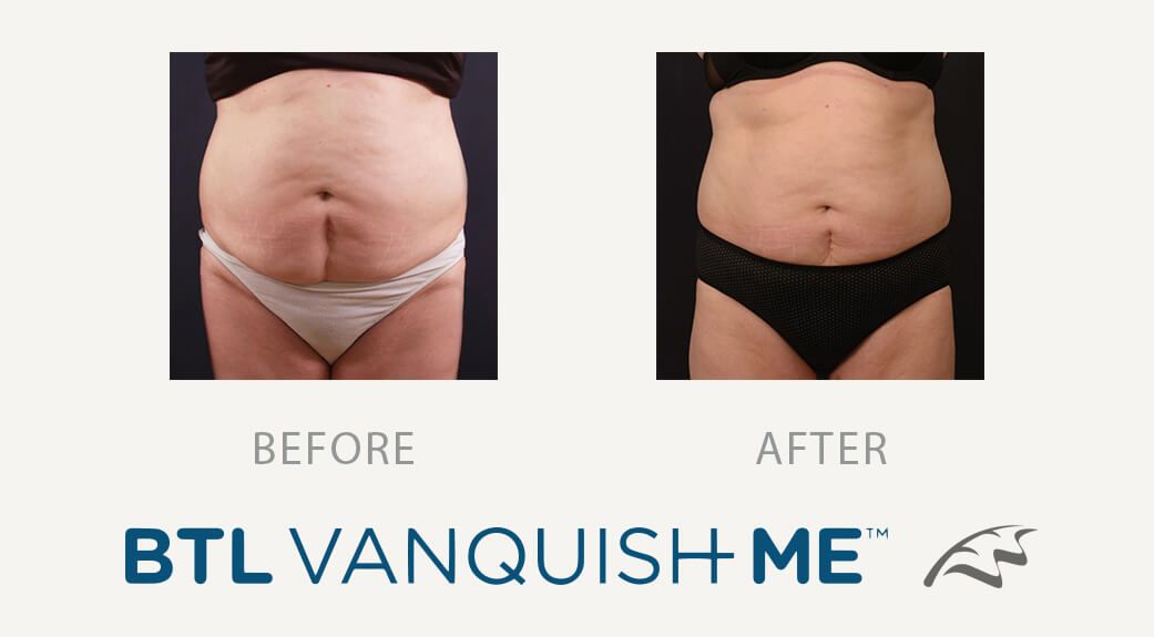 Vanquish  ME treatment abdominal tummy fat before and afters