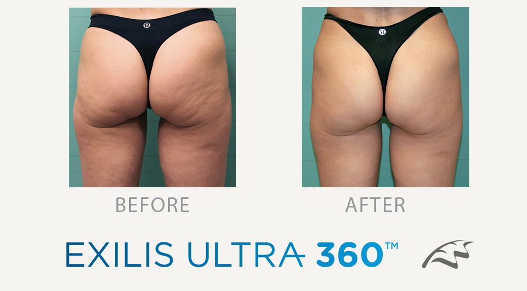 exilis_ultra_360_before_after_wimbledon_london