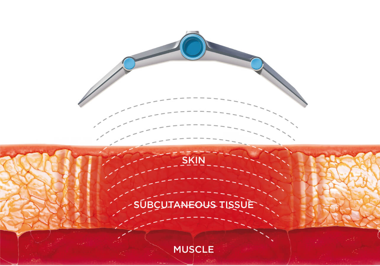 candela removal shallow deep follicle missed area