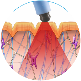 how the exilis ultra treatment stimulates the skin at the wimbledon clinic aesthetics department London