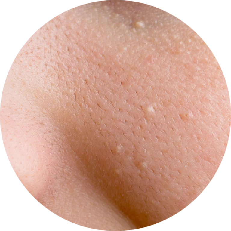 Milia Treatment wimbledon