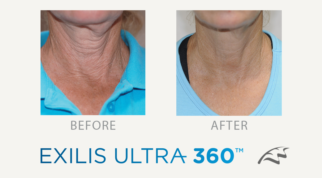 Exilis_before__after_face_neck_wimbledon_Clinic_south_west_london